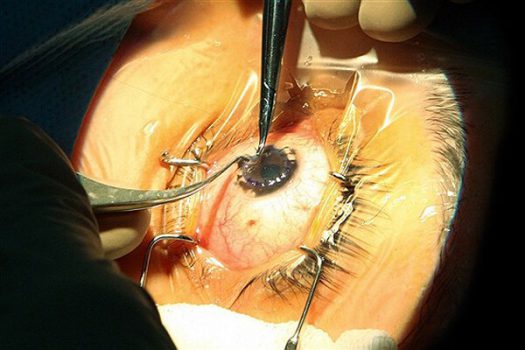 نخستین عمل جراحی پیوند قرنیه چشم در لرستان انجام شد