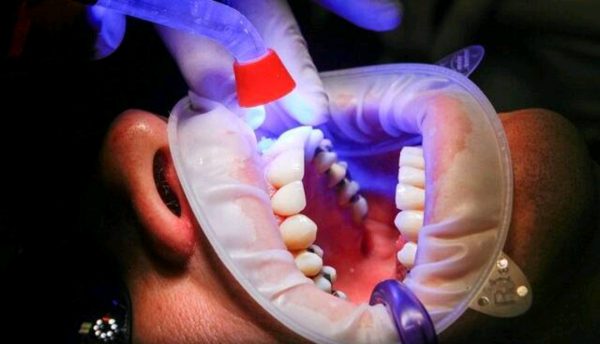 گامی مهم در علم دندانپزشکی؛ ایجاد مینای دندان با سلول‌های بنیادی