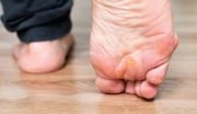 میخچه پا چیست و چگونه درمان می‌شود؟